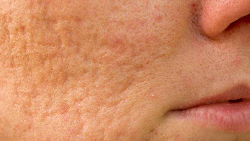 Acne Scarring