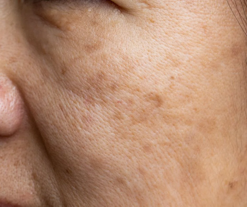 Challenges of Melasma